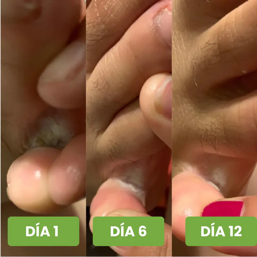 Adiós Hongo™ – Spray + Gotero Antifúngico