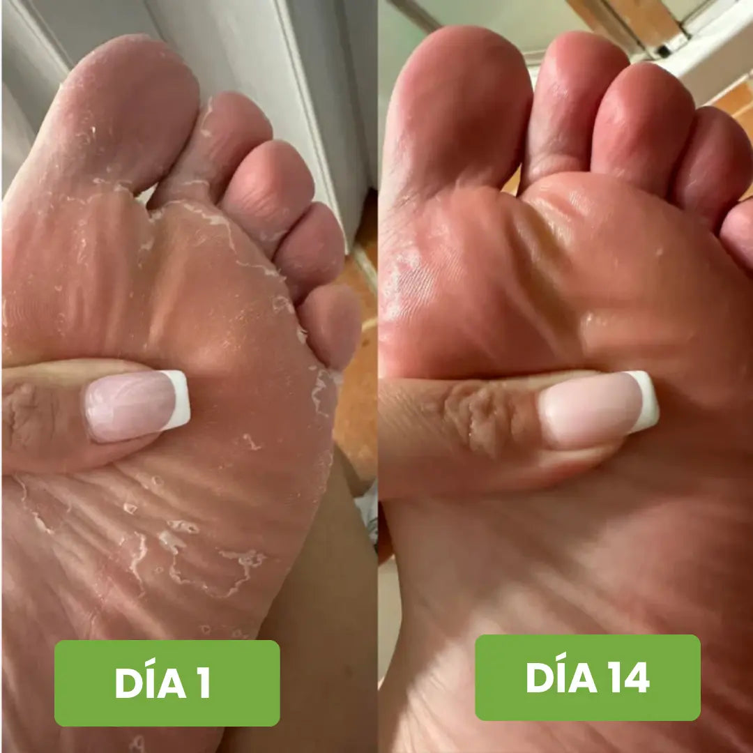 Adiós Hongo™ – Spray + Gotero Antifúngico